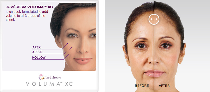 Some Known Incorrect Statements About How Long Does Juvederm Voluma Xc Last? About Juvederm Results Knoxville, Tn - Blog - Gallaher Plastic Surgery thumbnail