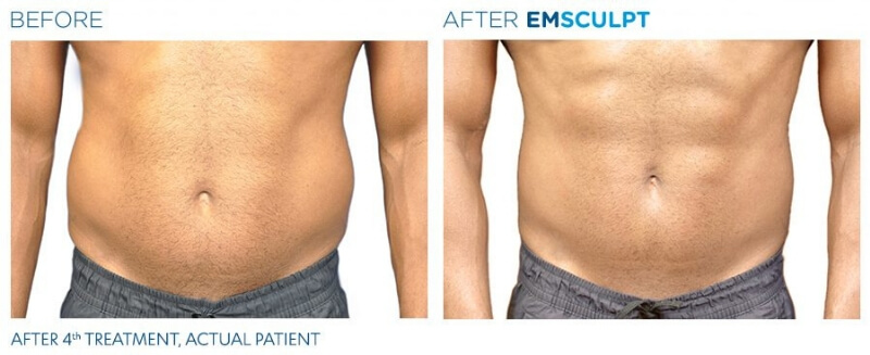 Results to Expect from Emsculpt Body Contouring Treatment - Just Melt Med  Spa